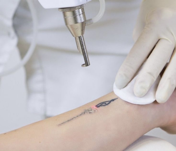 پاک کردن تتو در اهواز