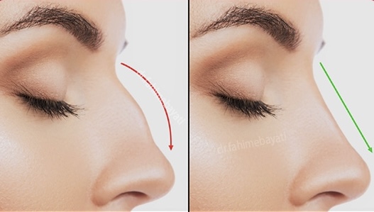 فرم دهی بینی در اهواز