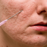 سابسیژن(رفع آکنه اسکار) در اهواز